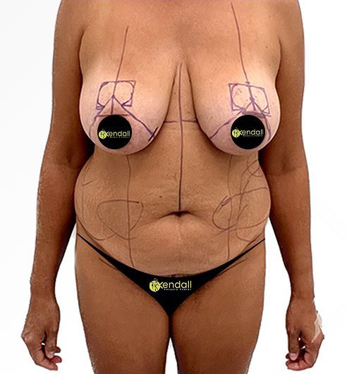 Breast Augmentation