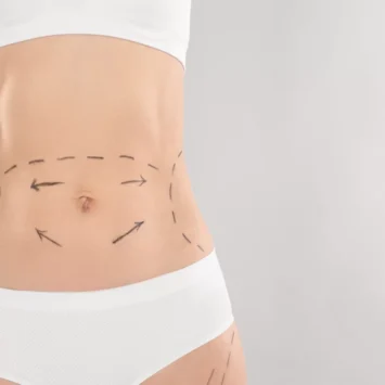 Circumferential Tummy Tuck