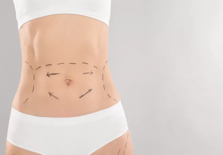 Circumferential Tummy Tuck