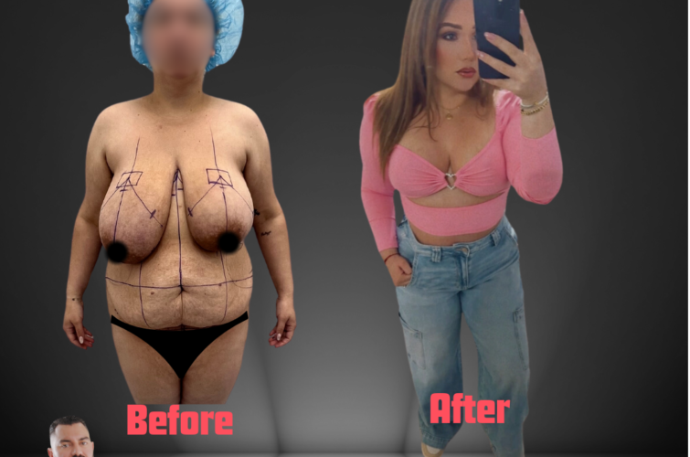 Breast Augmentation